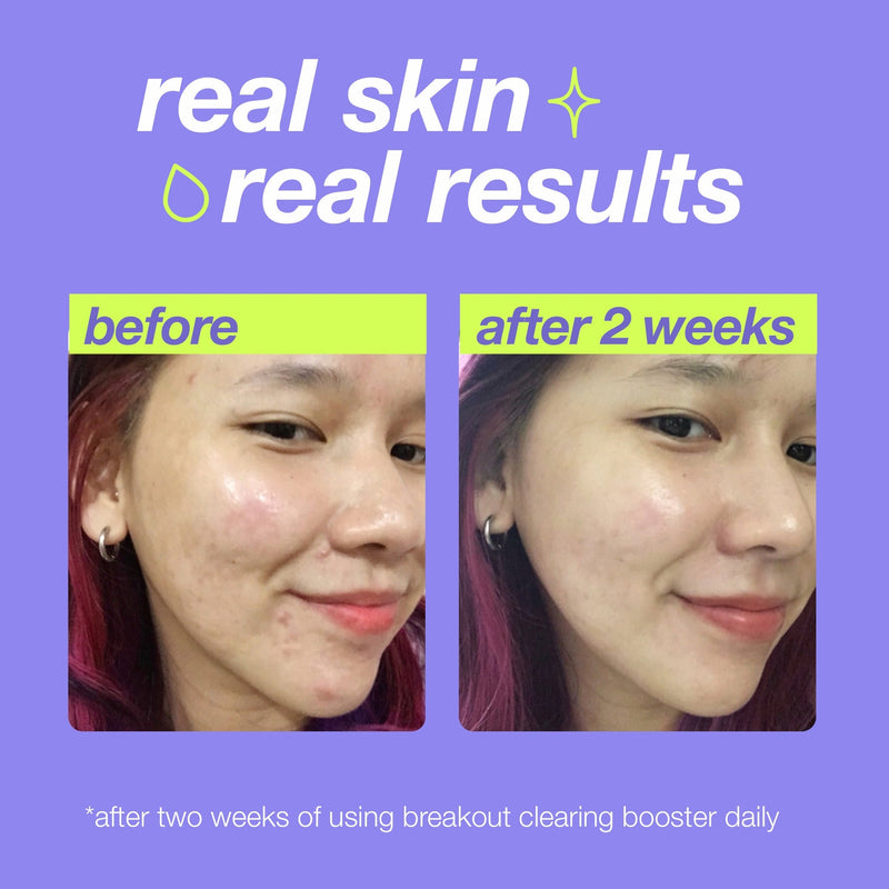 Clear Start Tratamento Anti Imperfeições Breakout Clearing Booster